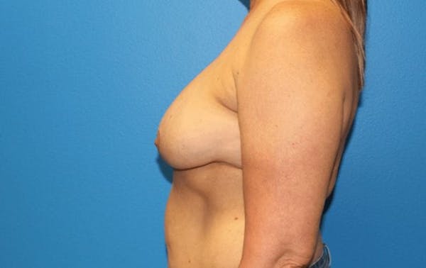 Staged Implant-Based Reconstruction Before & After Gallery - Patient 3689077 - Image 7