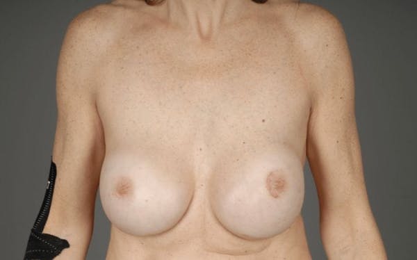 Staged Implant-Based Reconstruction Before & After Gallery - Patient 3689079 - Image 1