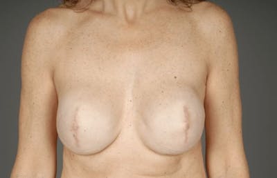 Staged Implant-Based Reconstruction Before & After Gallery - Patient 3689079 - Image 2