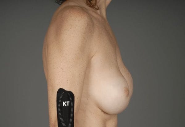 Staged Implant-Based Reconstruction Before & After Gallery - Patient 3689079 - Image 9