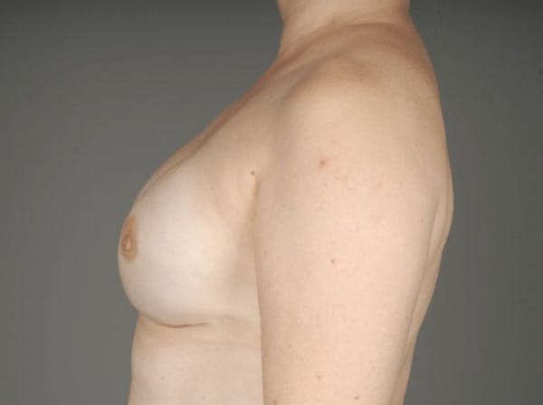 Direct-To-Implant Before & After Gallery - Patient 3689068 - Image 8