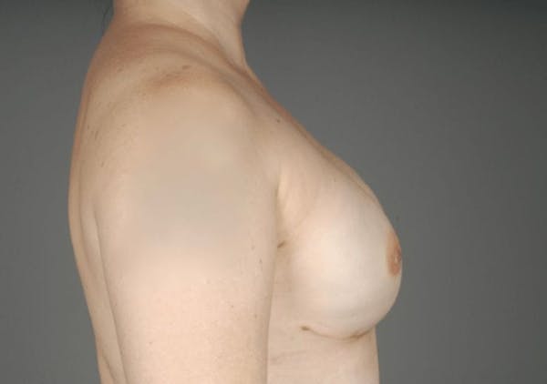 Direct-To-Implant Gallery - Patient 3689068 - Image 10
