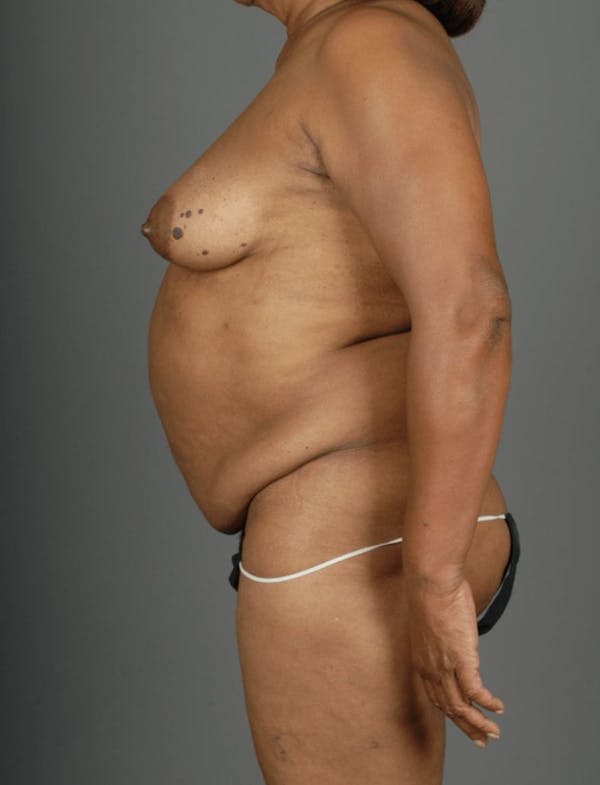 DIEP Flap Before & After Gallery - Patient 4002551 - Image 7