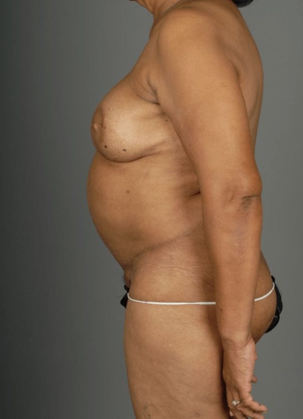 DIEP Flap Before & After Gallery - Patient 4002551 - Image 8