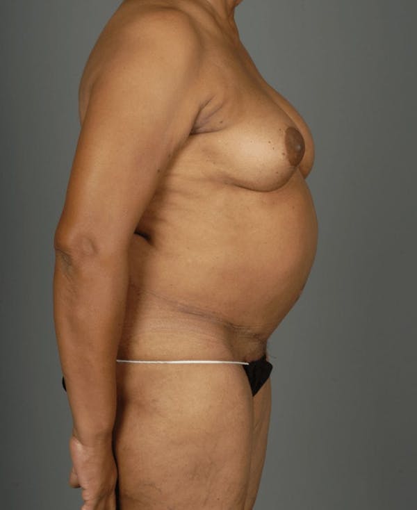 DIEP Flap Before & After Gallery - Patient 4002551 - Image 10