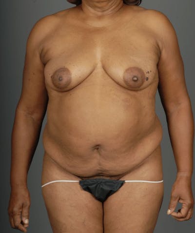 DIEP Flap Before & After Gallery - Patient 4002551 - Image 1