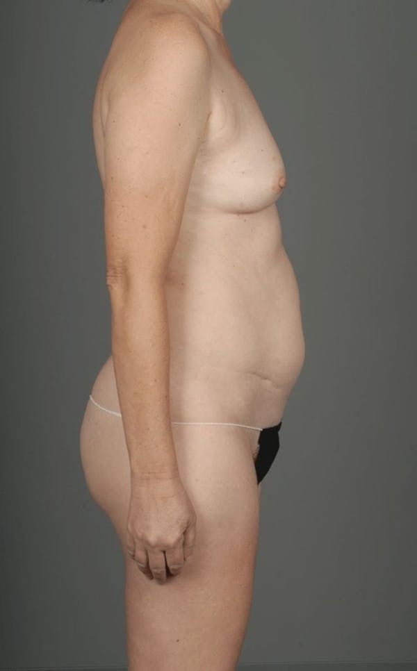 DIEP Flap Before & After Gallery - Patient 4002548 - Image 7