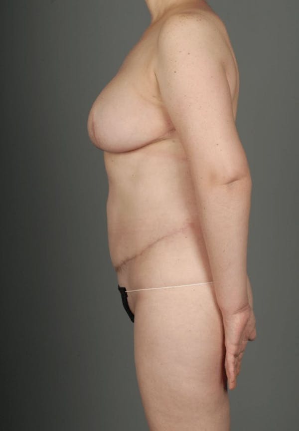 DIEP Flap Before & After Gallery - Patient 4002549 - Image 8
