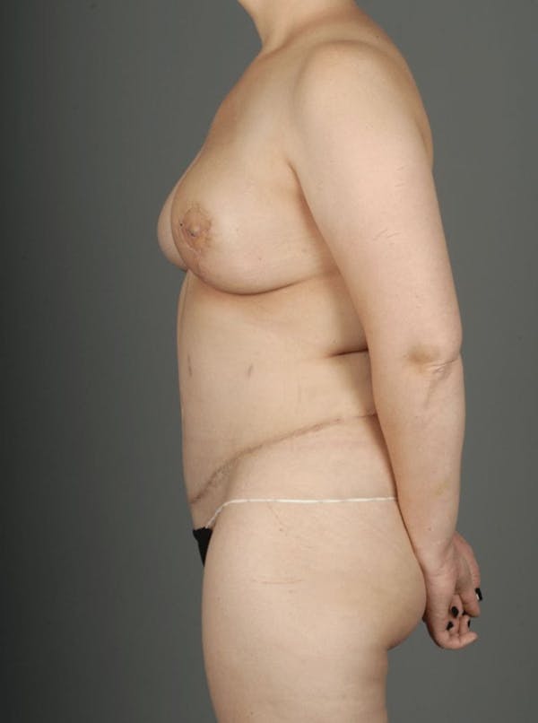 DIEP Flap Before & After Gallery - Patient 4002550 - Image 8