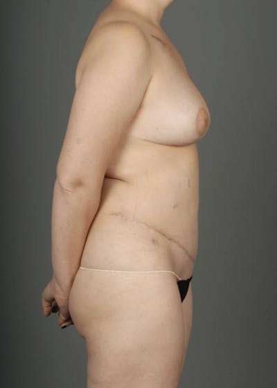 DIEP Flap Before & After Gallery - Patient 4002550 - Image 10