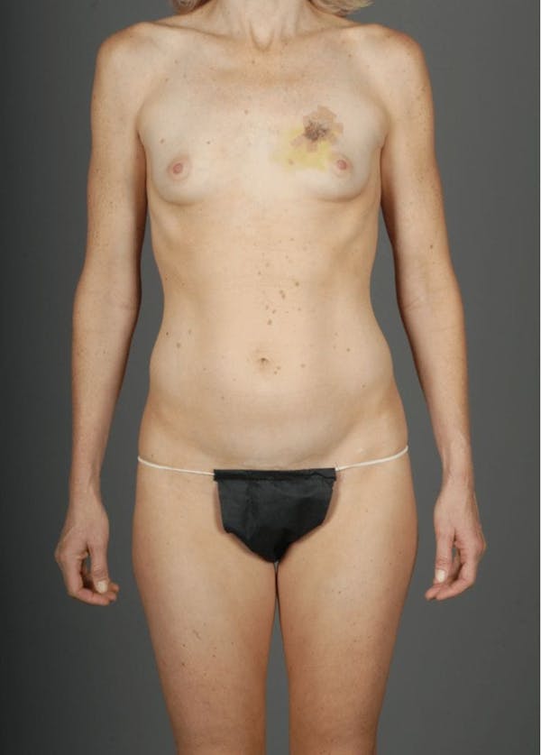 DIEP Flap Before & After Gallery - Patient 4006301 - Image 1