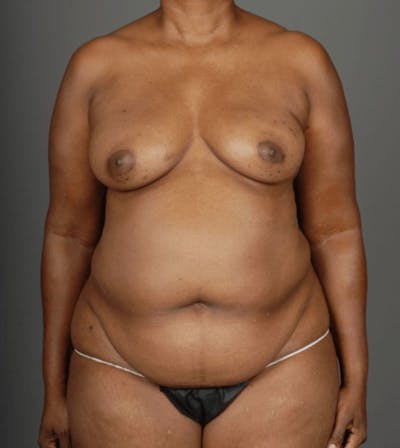 DIEP Flap Before & After Gallery - Patient 4006303 - Image 1