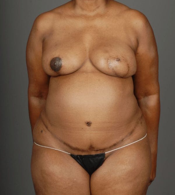 DIEP Flap Before & After Gallery - Patient 4006303 - Image 2