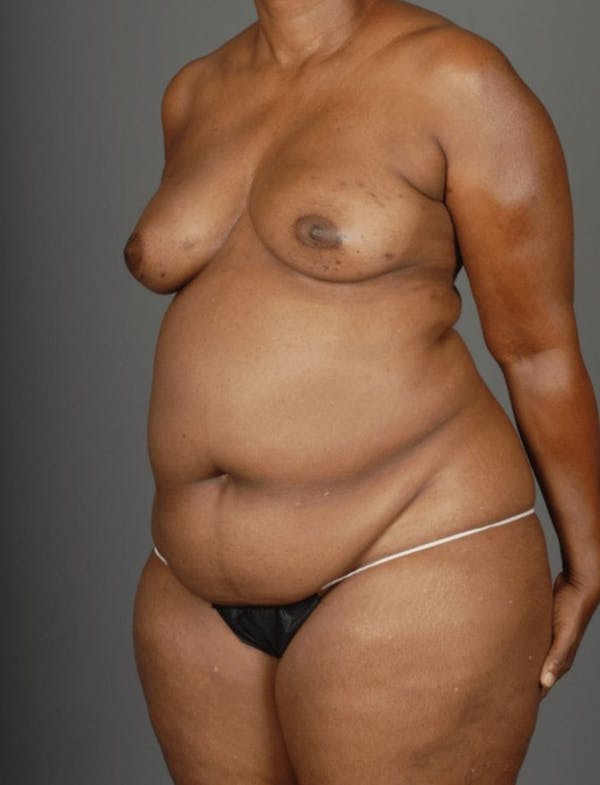 DIEP Flap Before & After Gallery - Patient 4006303 - Image 3