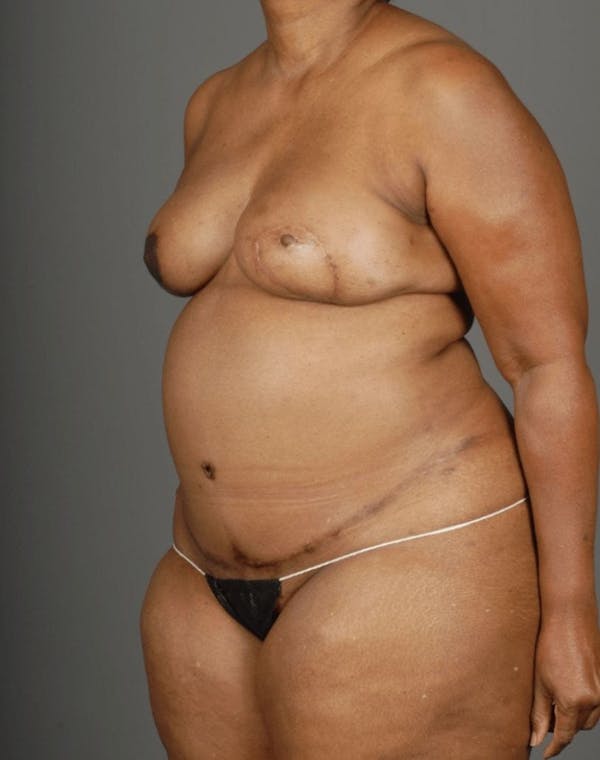 DIEP Flap Before & After Gallery - Patient 4006303 - Image 4