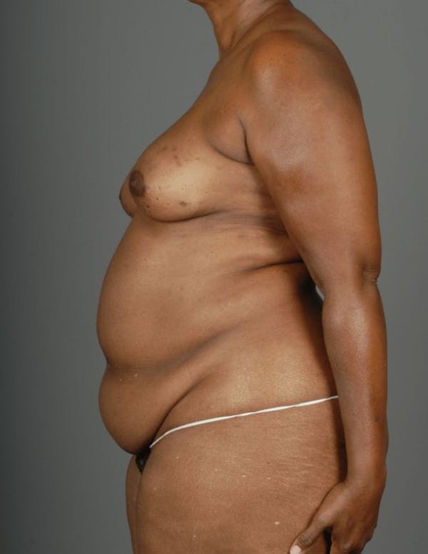 DIEP Flap Before & After Gallery - Patient 4006303 - Image 7