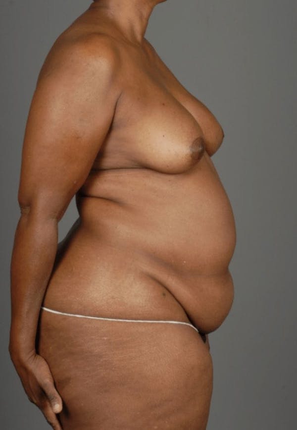DIEP Flap Before & After Gallery - Patient 4006303 - Image 9