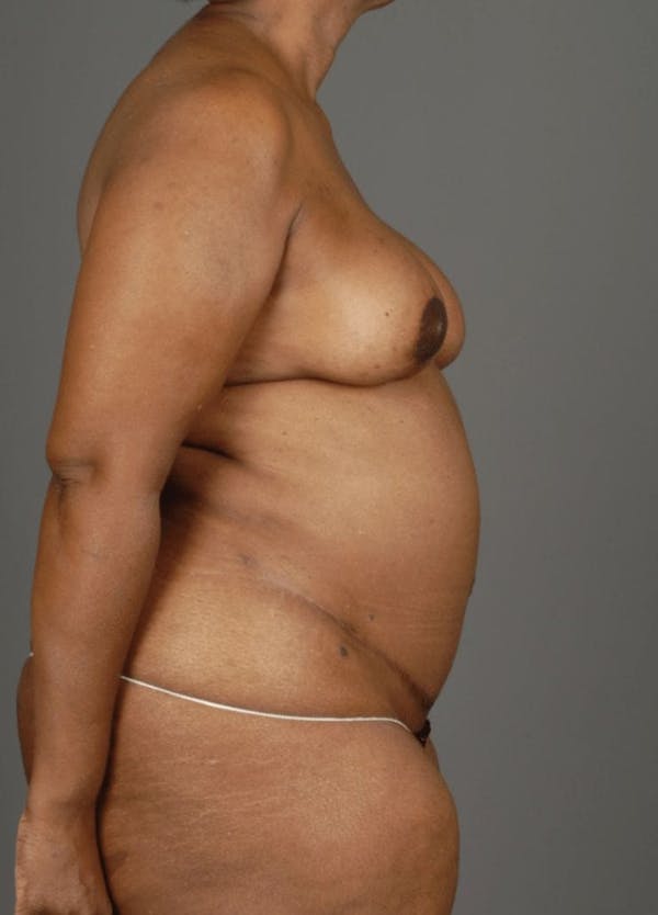 DIEP Flap Before & After Gallery - Patient 4006303 - Image 10