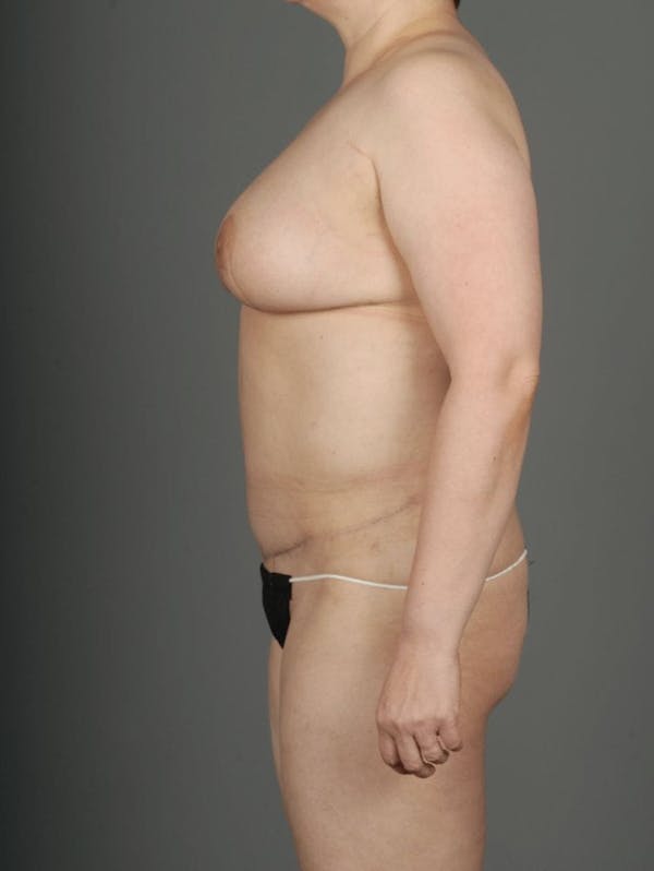 DIEP Flap Before & After Gallery - Patient 4005860 - Image 7