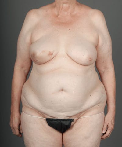 DIEP Flap Before & After Gallery - Patient 4005861 - Image 1
