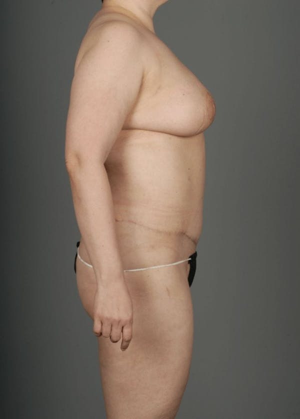 DIEP Flap Before & After Gallery - Patient 4005860 - Image 8