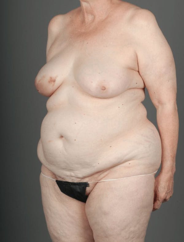 DIEP Flap Before & After Gallery - Patient 4005861 - Image 3