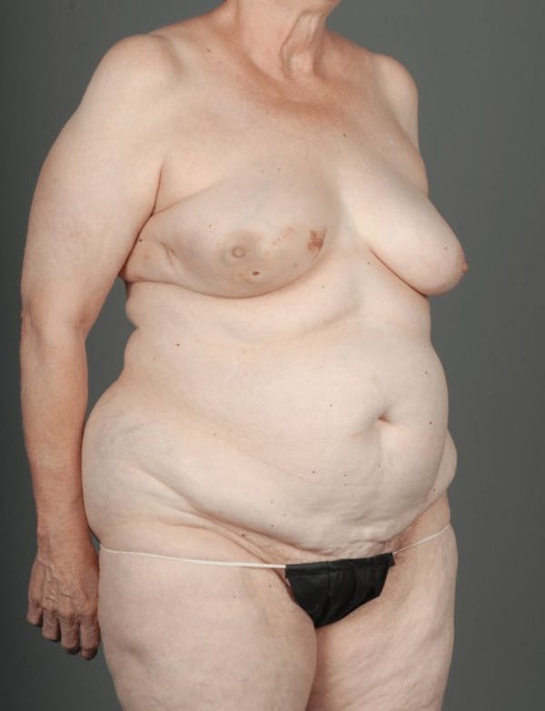 DIEP Flap Before & After Gallery - Patient 4005861 - Image 5