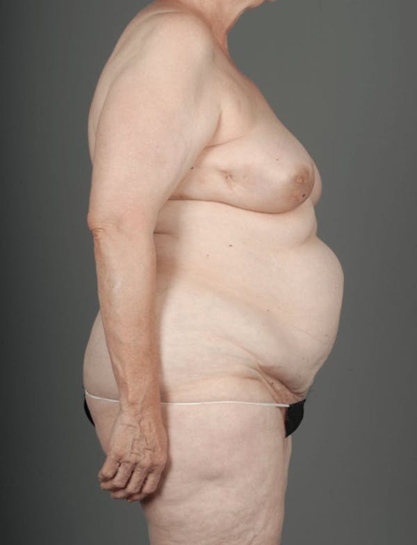 DIEP Flap Before & After Gallery - Patient 4005861 - Image 7