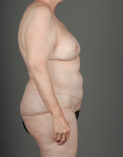 DIEP Flap Before & After Gallery - Patient 4005861 - Image 8