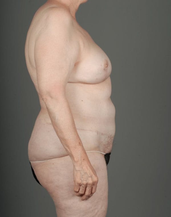 DIEP Flap Before & After Gallery - Patient 4005861 - Image 8