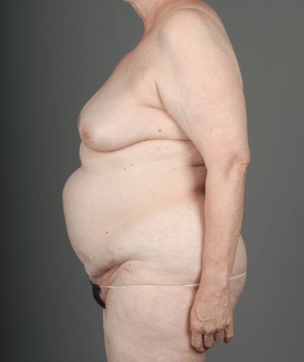 DIEP Flap Before & After Gallery - Patient 4005861 - Image 9