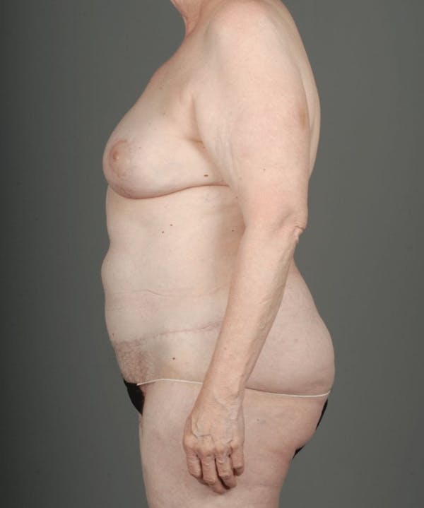 DIEP Flap Before & After Gallery - Patient 4005861 - Image 10