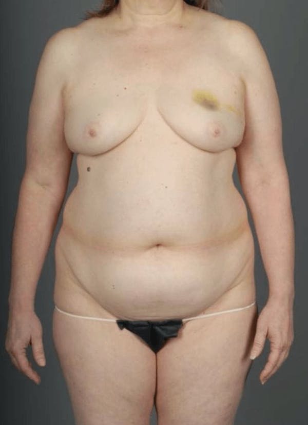 DIEP Flap Before & After Gallery - Patient 4005862 - Image 1