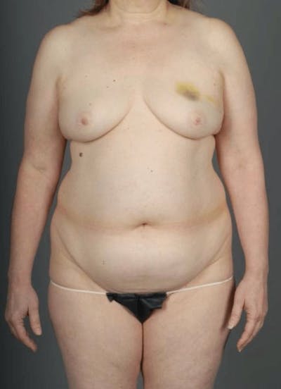 DIEP Flap Before & After Gallery - Patient 4005862 - Image 1