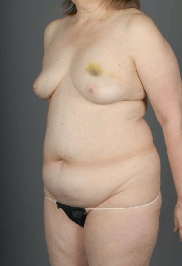 DIEP Flap Before & After Gallery - Patient 4005862 - Image 3