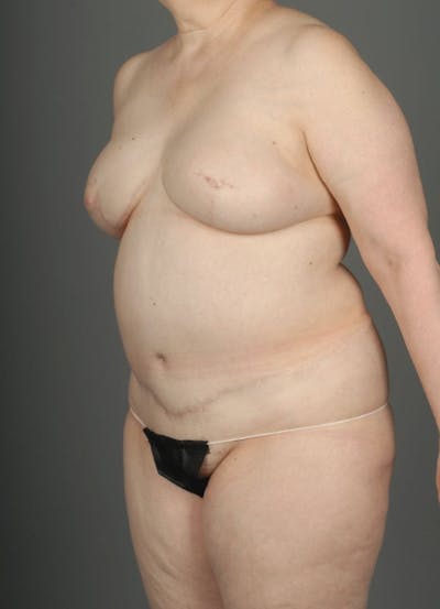 DIEP Flap Before & After Gallery - Patient 4005862 - Image 4