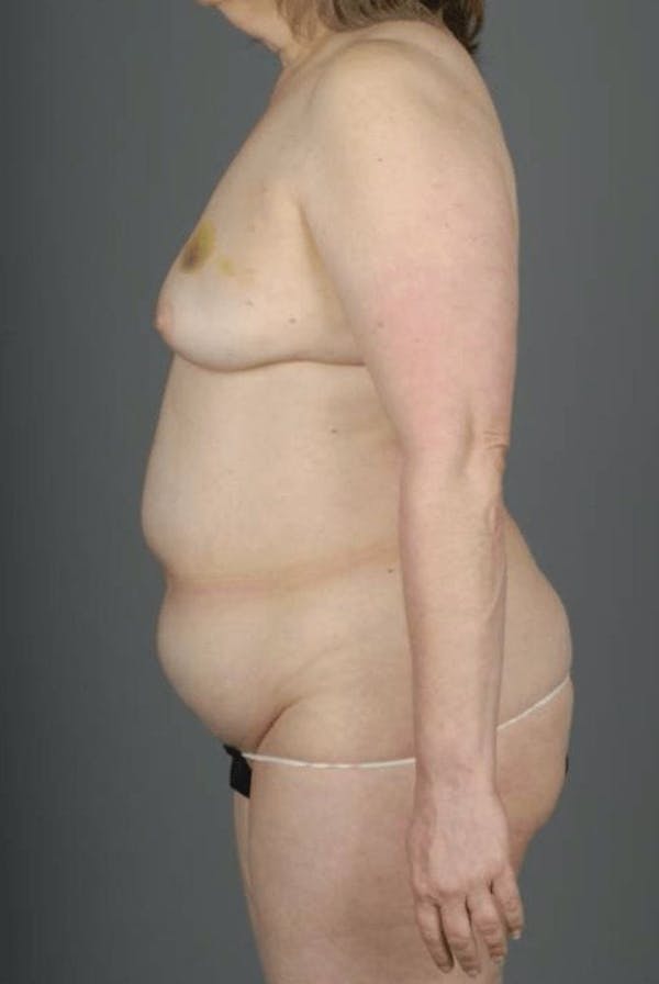 DIEP Flap Before & After Gallery - Patient 4005862 - Image 7