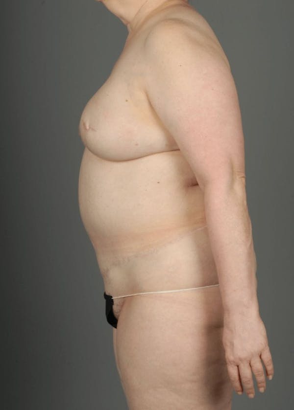 DIEP Flap Before & After Gallery - Patient 4005862 - Image 8