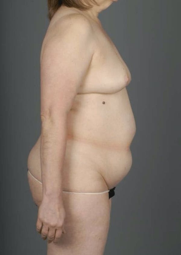 DIEP Flap Before & After Gallery - Patient 4005862 - Image 9