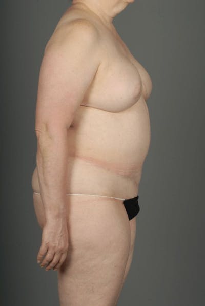 DIEP Flap Before & After Gallery - Patient 4005862 - Image 10