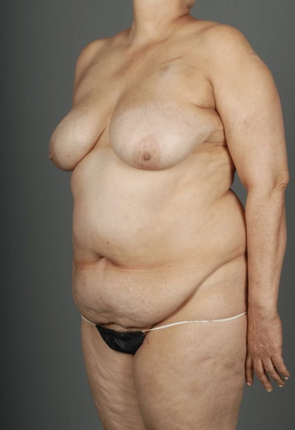 DIEP Flap Before & After Gallery - Patient 4005863 - Image 3