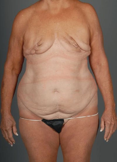DIEP Flap Before & After Gallery - Patient 4006383 - Image 1