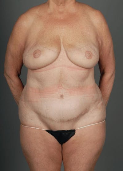 DIEP Flap Before & After Gallery - Patient 4006383 - Image 2