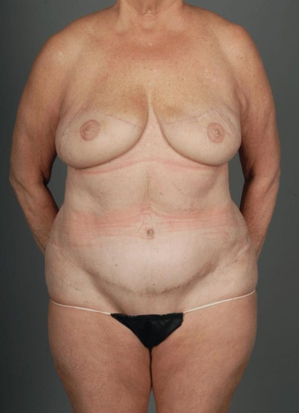 DIEP Flap Before & After Gallery - Patient 4006383 - Image 2