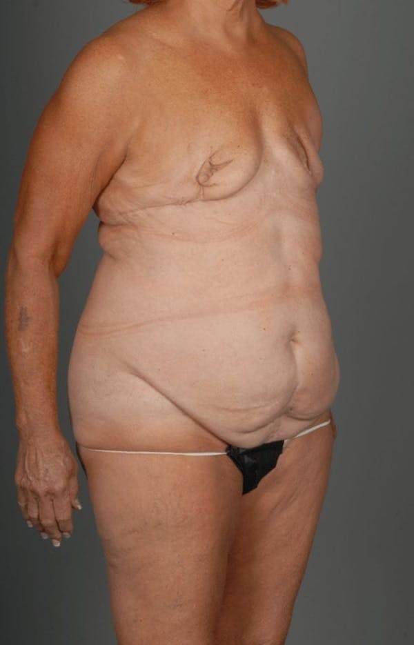 DIEP Flap Before & After Gallery - Patient 4006383 - Image 3