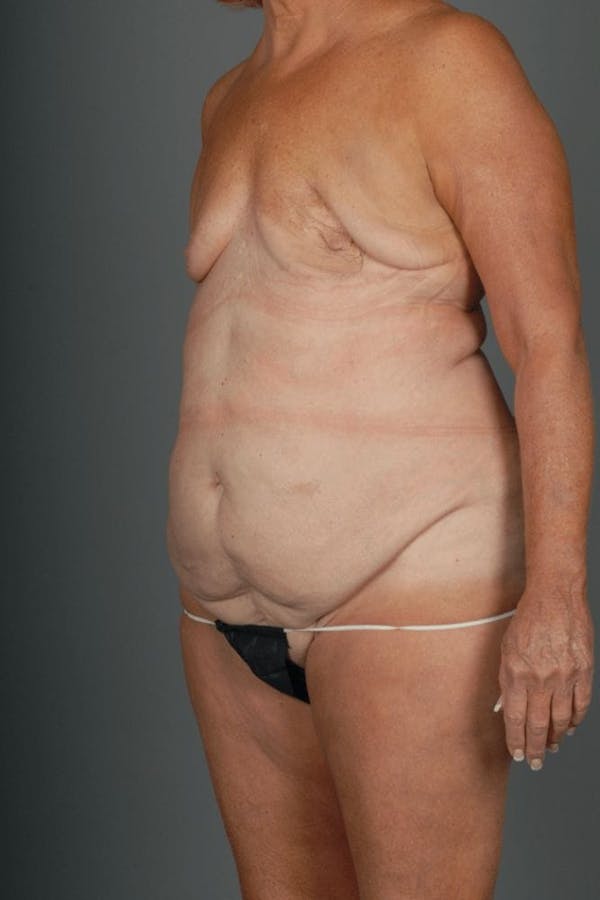DIEP Flap Before & After Gallery - Patient 4006383 - Image 5
