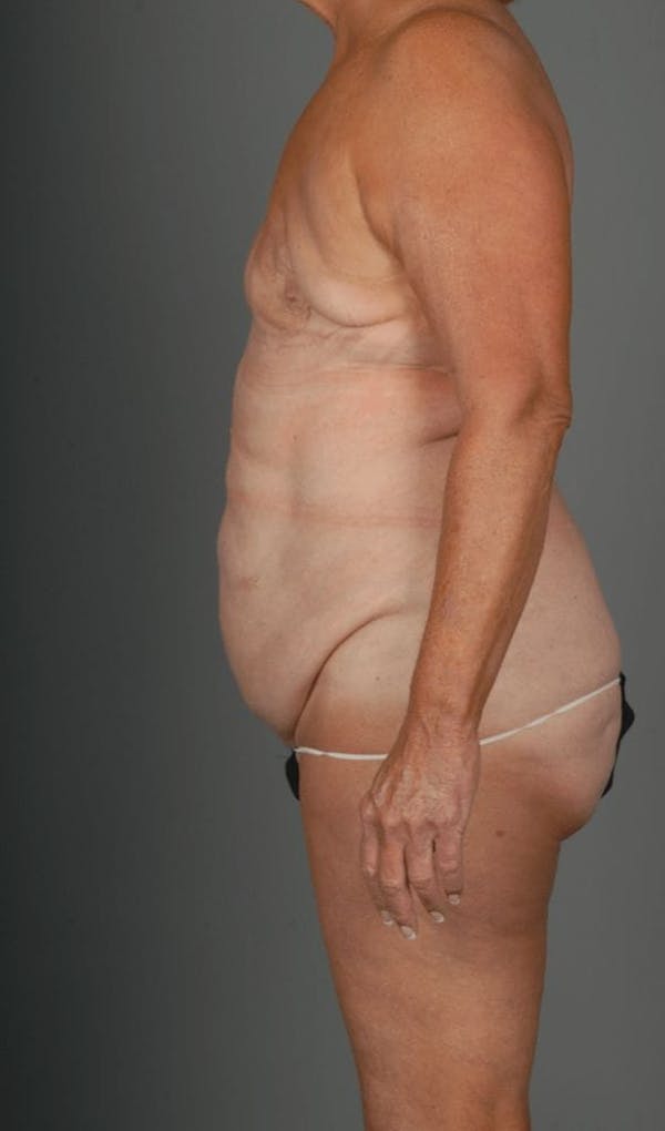 DIEP Flap Before & After Gallery - Patient 4006383 - Image 7