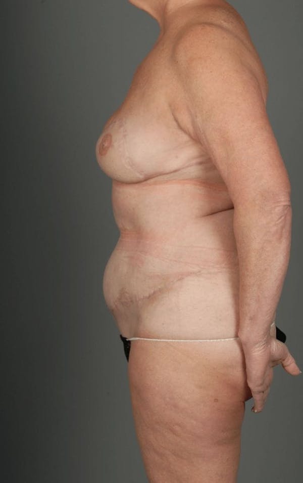 DIEP Flap Before & After Gallery - Patient 4006383 - Image 8
