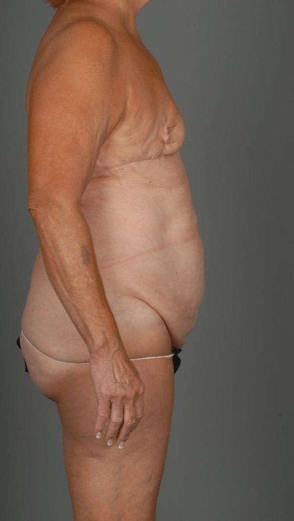 DIEP Flap Before & After Gallery - Patient 4006383 - Image 9
