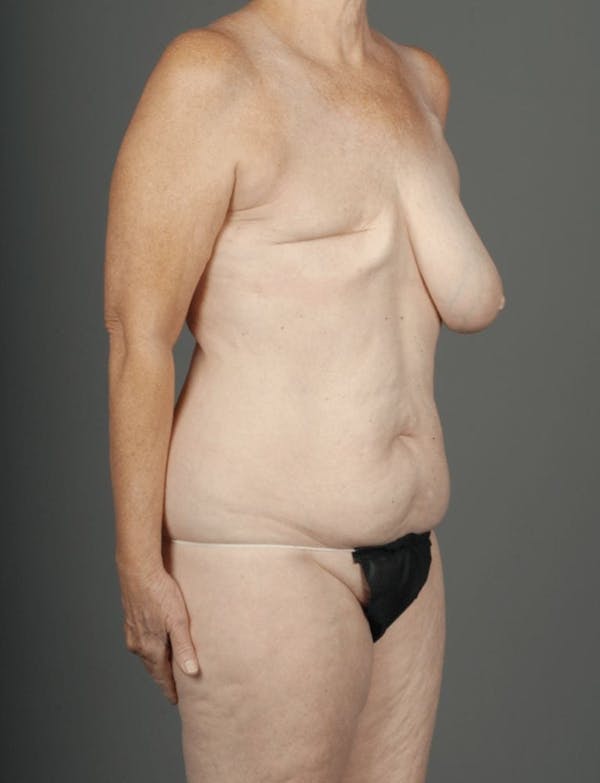 DIEP Flap Before & After Gallery - Patient 4006384 - Image 5